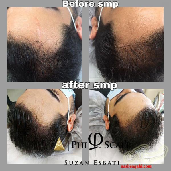 میکرو اسکالپ