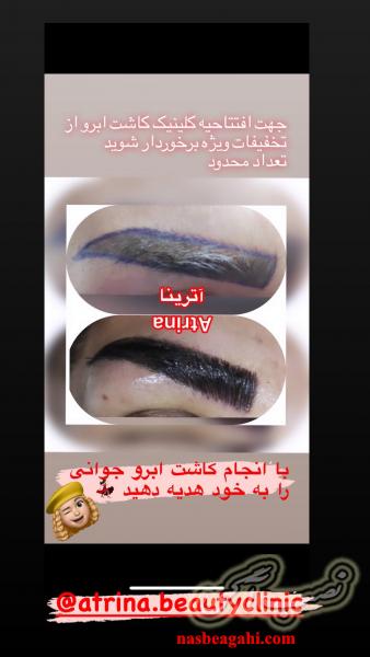 کاشت ابرو با حداقل هزینه فقط 3500000