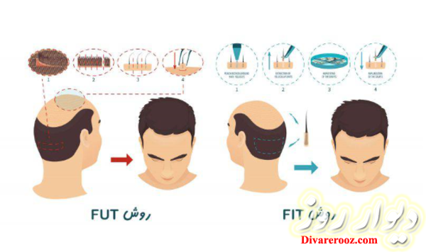 کاشت مو طبیعی در نهال ایران