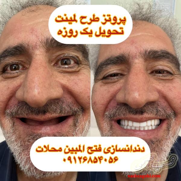 دندانسازی محلات ( فتح المبین )