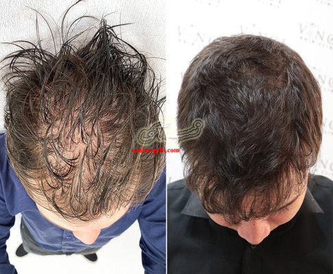 پی آر پی و درمان ریزش مو