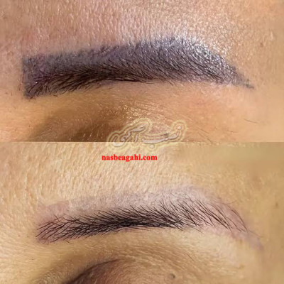 ریموو تاتو قدیمی و بدرنگ ابرو